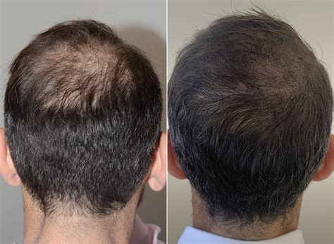 smp bugil|Scalp Micropigmentation in Miami 